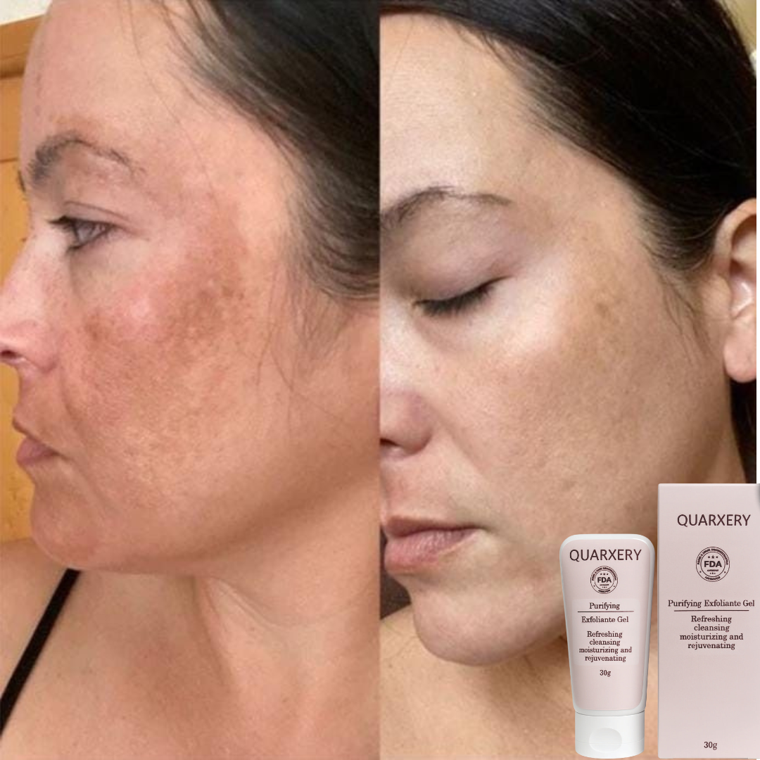 Exfoliante Quarxery™: Ideal para manchas y puntos negros.
