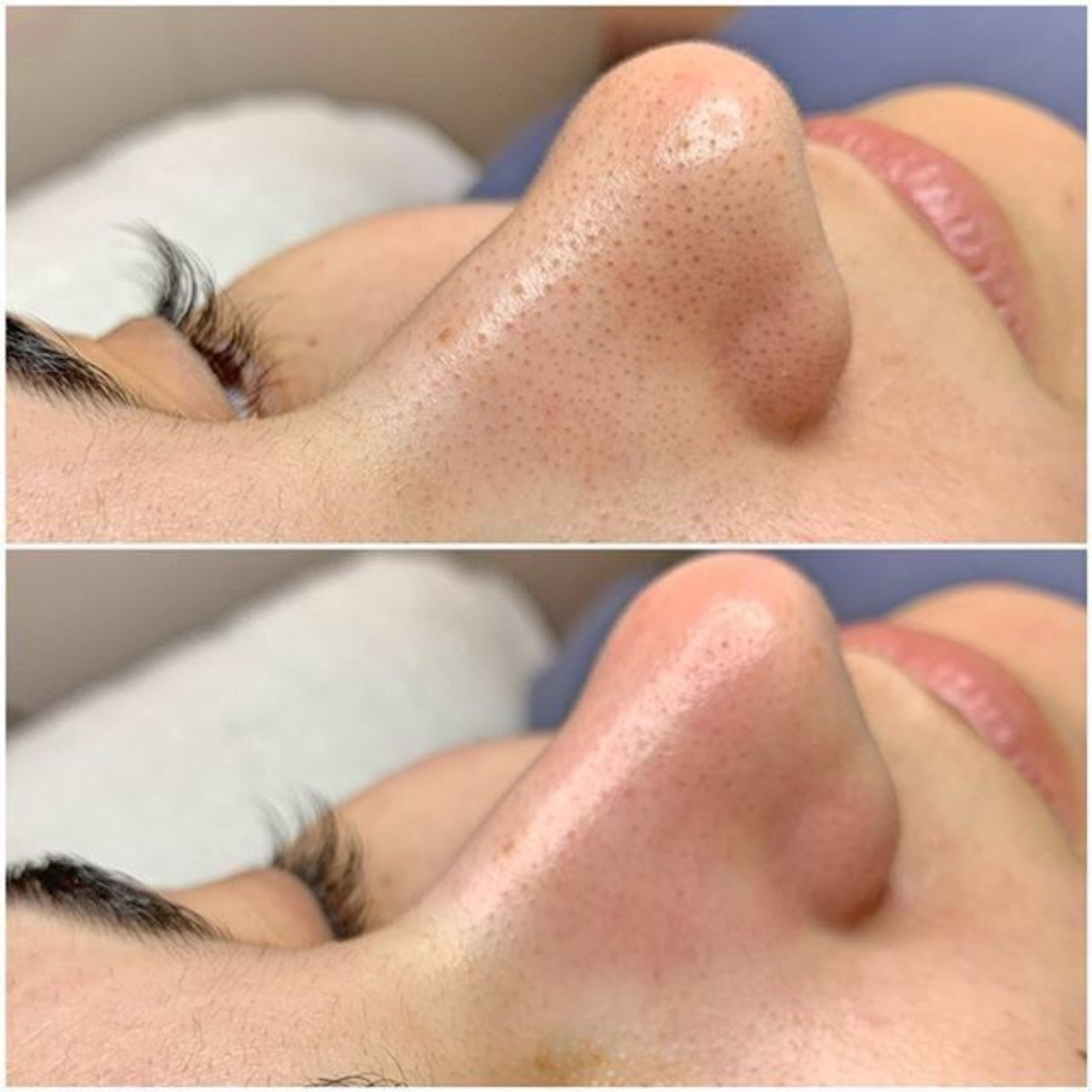 Exfoliante Quarxery™: Ideal para manchas y puntos negros.