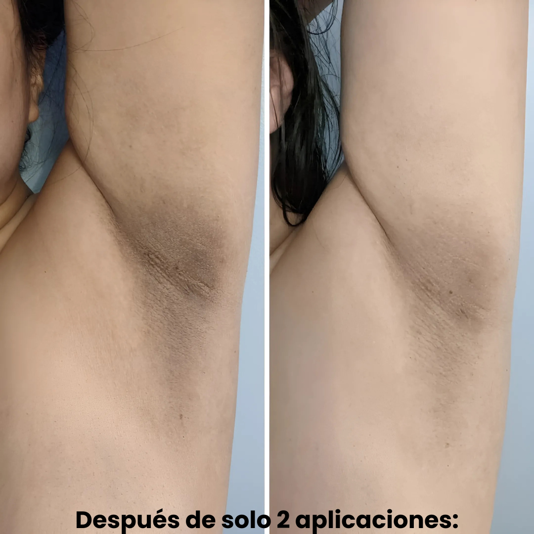 Exfoliante Quarxery™: Ideal para manchas y puntos negros.
